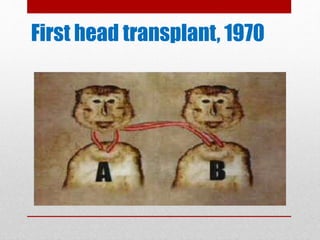 First head transplant, 1970
 