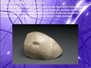 Depressed Skull Fracture : 
are often the result of a severe blow to the head with a blunt object. 
Unlike linear skull fractures, which only break the surface of the skull, 
broken skull fragments from depressed skull fractures penetrate or 
compress brain tissue and can cause severe brain damage 
 