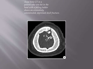 Axial bone CT in a
patient who was hit in the
head with a falling ladder
shows an extensively
comminuted, depressed skull fracture.
 