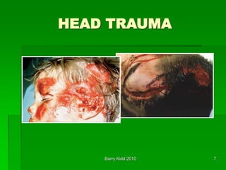 Barry Kidd 2010 7
HEAD TRAUMA
 