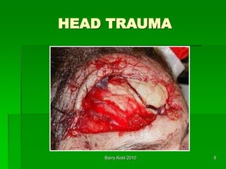 Barry Kidd 2010 9
HEAD TRAUMA
 