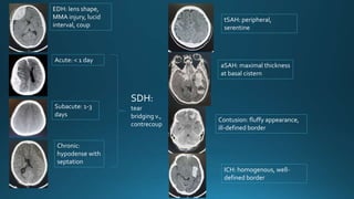 EDH: lens shape,
MMA injury, lucid
interval, coup
Acute: < 1 day
Subacute: 1-3
days
Chronic:
hypodense with
septation
SDH:
tear
bridging v.,
contrecoup
tSAH: peripheral,
serentine
aSAH: maximal thickness
at basal cistern
Contusion: fluffy appearance,
ill-defined border
ICH: homogenous, well-
defined border
 