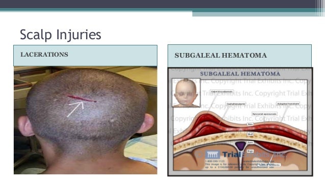 Head Trauma Management