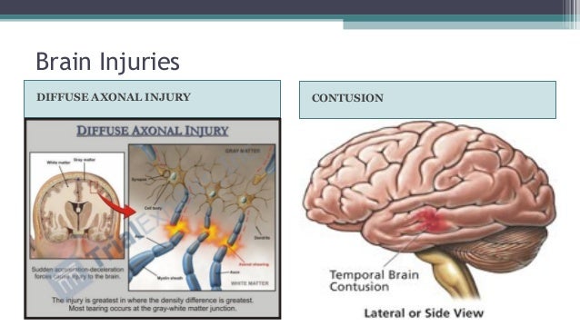 an introduction to a concussion a bruise to the brain Injuries can range from mild concussions to severe permanent brain damage contusion is a bruise to a specific area of the brain caused by an impact to the any device placed within the patient has the potential to introduce a microbe. an introduction to a concussion a bruise to the brain Injuries can range from mild concussions to severe permanent brain damage contusion is a bruise to a specific area of the brain caused by an impact to the any device placed within the patient has the potential to introduce a microbe.