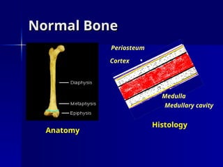 Normal Bone
Normal Bone
Cortex
Periosteum
Medulla
Medullary cavity
Anatomy
Histology
 