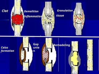 Clot Demolition
Inflammation
Granulation
tissue
Calus
formation
Gap
unio
n
Remodeling
 