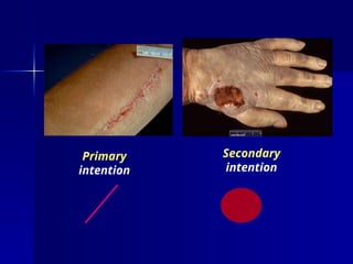 Primary
intention
Secondary
intention
 