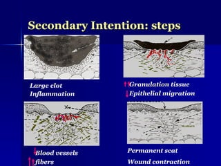 Secondary Intention: steps
Secondary Intention: steps
Large clot
Inflammation
Granulation tissue
Epithelial migration
Blood vessels
fibers
Permanent scat
Wound contraction
 
