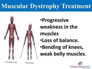 Muscular Dystrophy Treatment
•Progressive
weakness in the
muscles
•Loss of balance.
•Bending of knees,
weak belly muscles.
 