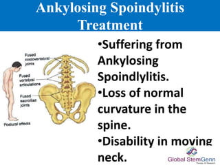 Ankylosing Spoindylitis
Treatment
•Suffering from
Ankylosing
Spoindlylitis.
•Loss of normal
curvature in the
spine.
•Disability in moving
neck.
 