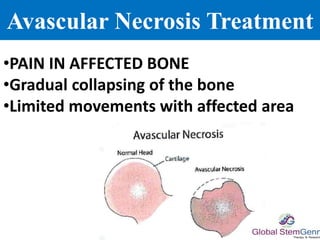 Avascular Necrosis Treatment
•PAIN IN AFFECTED BONE
•Gradual collapsing of the bone
•Limited movements with affected area
 