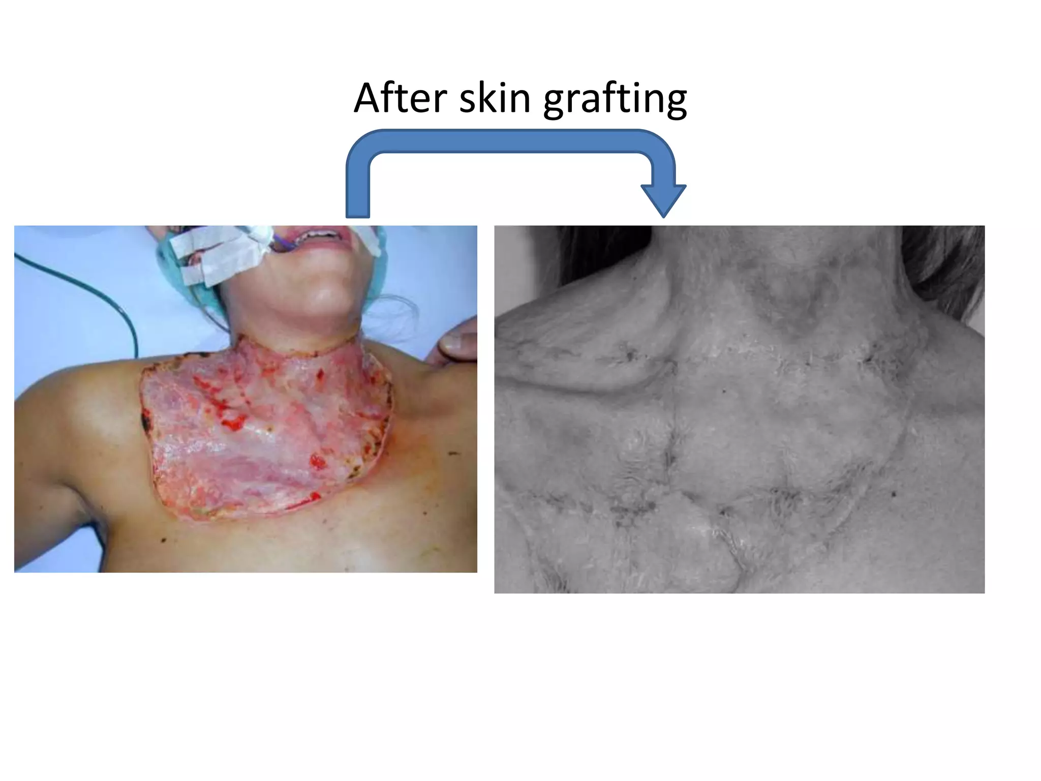 After skin grafting
 
