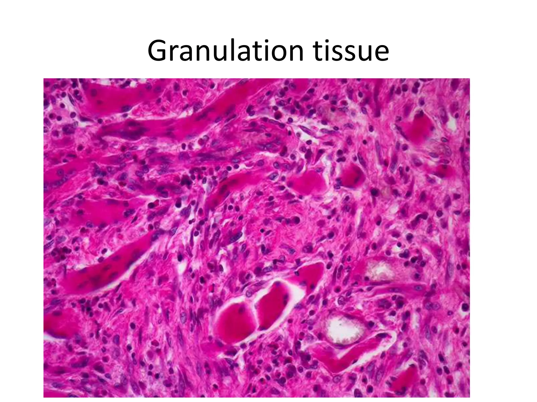 Granulation tissue
 