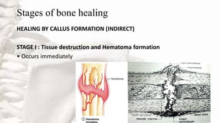Stages of bone healing
HEALING BY CALLUS FORMATION (INDIRECT)
STAGE I : Tissue destruction and Hematoma formation
• Occurs immediately
 