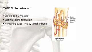 STAGE IV : Consolidation
• Weeks to 2-3 months
• Lamellar bone formation
• Remaining gaps filled by lamellar bone
 