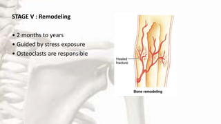 STAGE V : Remodeling
• 2 months to years
• Guided by stress exposure
• Osteoclasts are responsible
 