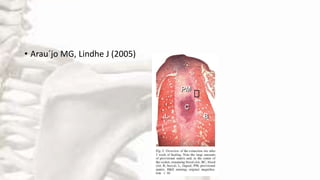 • Arau´jo MG, Lindhe J (2005)
 