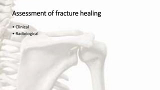 Assessment of fracture healing
• Clinical
• Radiological
 