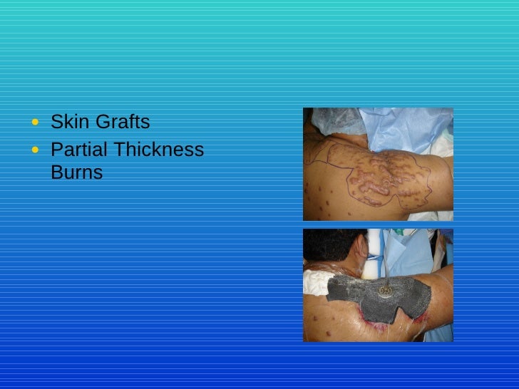 Healing The Wound The Vac System In Woundcare