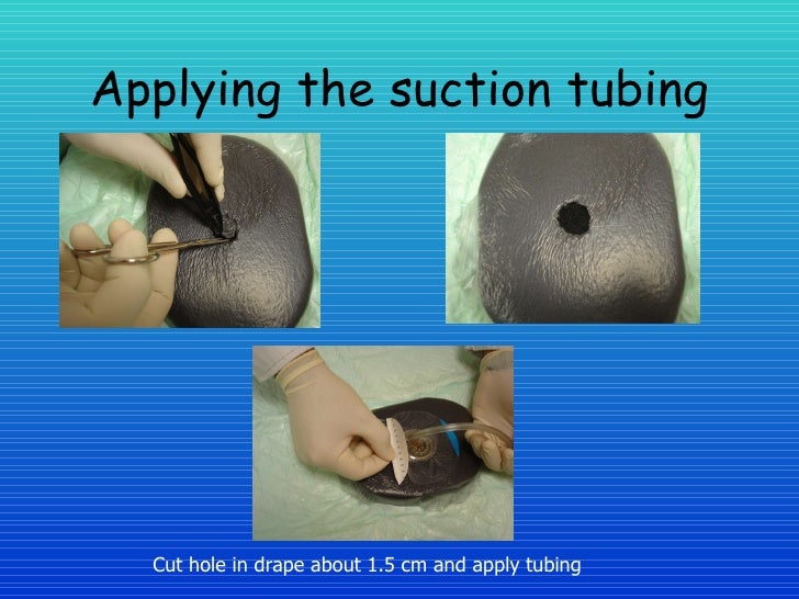 Healing The Wound The Vac System In Woundcare