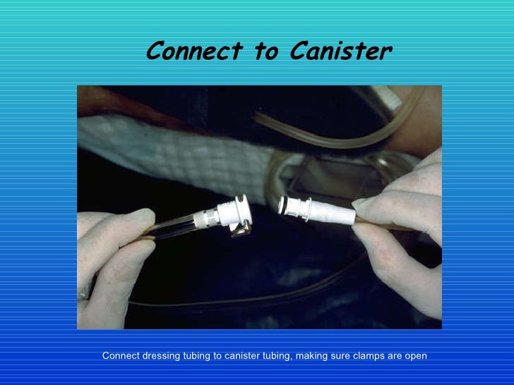 Healing The Wound The Vac System In Woundcare