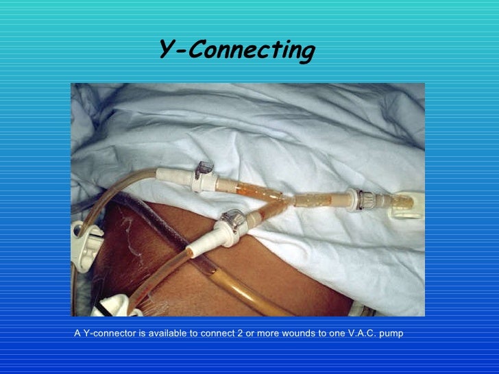 Healing The Wound The Vac System In Woundcare