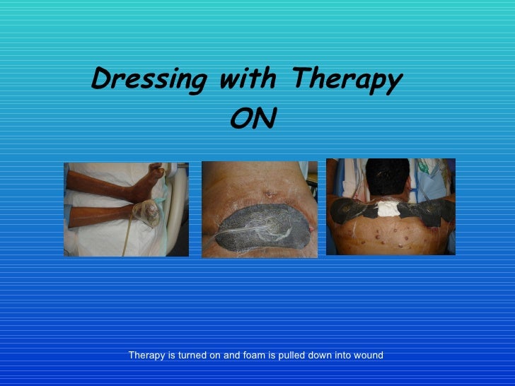 Healing The Wound The Vac System In Woundcare