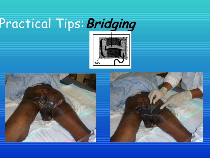 Healing The Wound The Vac System In Woundcare