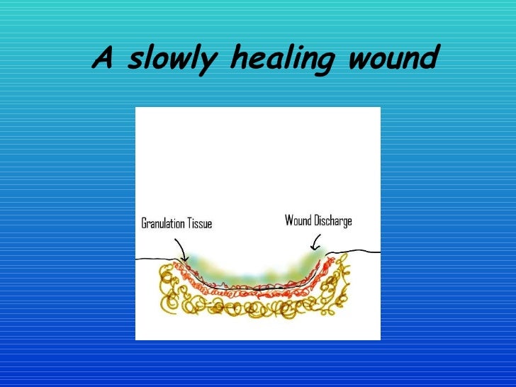 Healing The Wound The Vac System In Woundcare