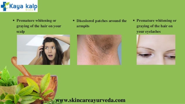 Ayurvedic Vitiligo Treatment In India Ayurvedic Treatment For White