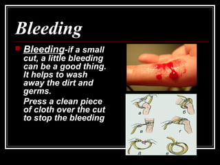 Bleeding
 BleedingBleeding-if a small-if a small
cut, a little bleedingcut, a little bleeding
can be a good thing.can be ...