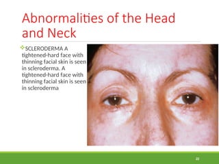 Scleroderma Rash Neck Health-Assessment-Lab Hea88d and neck.ppt