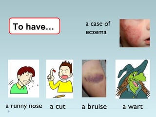 a runny nose a cut a wart
a case of
eczema
To have…
a bruise
 