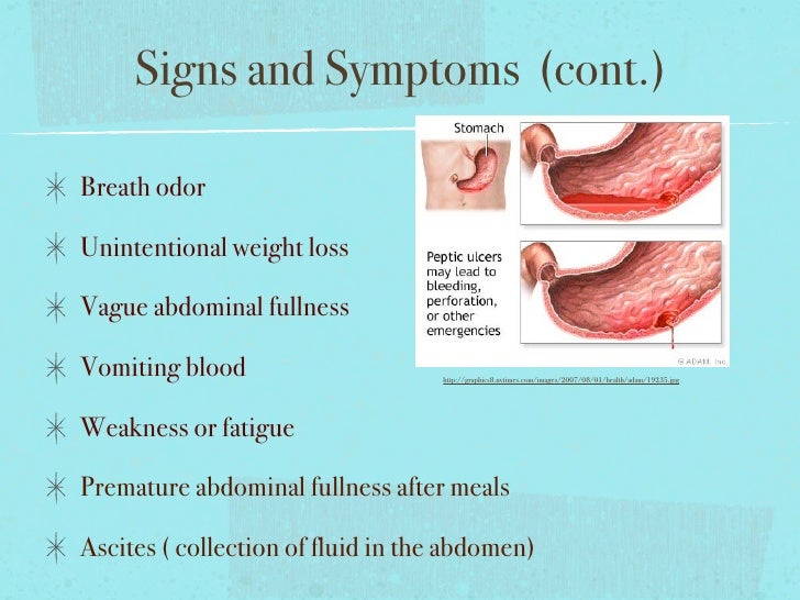 Health 10 Ppt1. Stomach Cancer