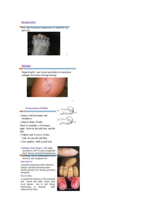 Keloids:
Hypertrophic scar tissue secondary to excessive
collagen formation during healing.
48
 