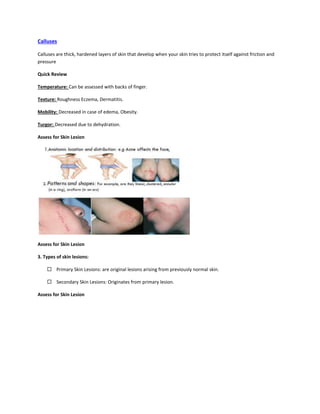 Calluses
Calluses are thick, hardened layers of skin that develop when your skin tries to protect itself against friction and
pressure
Quick Review
Temperature: Can be assessed with backs of finger.
Texture: Roughness Eczema, Dermatitis.
Mobility: Decreased in case of edema, Obesity.
Turgor: Decreased due to dehydration.
Assess for Skin Lesion
Assess for Skin Lesion
3. Types of skin lesions:
 Primary Skin Lesions: are original lesions arising from previously normal skin.
 Secondary Skin Lesions: Originates from primary lesion.
Assess for Skin Lesion
 