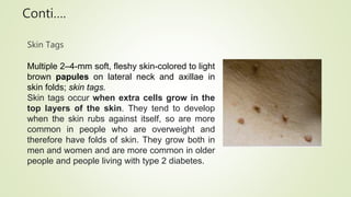 Skin Tag Identification Health Assessment Findings on Skin Assessment.pptx