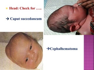  Head: Check for …..
 Caput succedaneum
Cephalhematoma
 