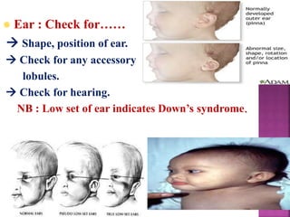  Ear : Check for……
 Shape, position of ear.
 Check for any accessory
lobules.
 Check for hearing.
NB : Low set of ear indicates Down’s syndrome.
 