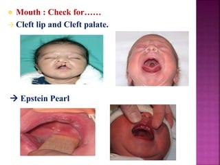  Mouth : Check for……
 Cleft lip and Cleft palate.
 Epstein Pearl
 