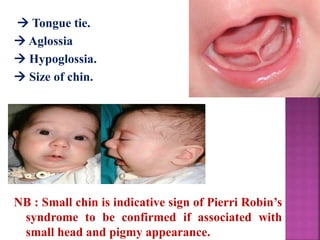  Tongue tie.
 Aglossia
 Hypoglossia.
 Size of chin.
NB : Small chin is indicative sign of Pierri Robin’s
syndrome to be confirmed if associated with
small head and pigmy appearance.
 