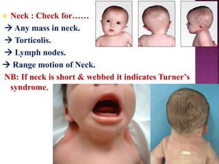  Neck : Check for……
 Any mass in neck.
 Torticolis.
 Lymph nodes.
 Range motion of Neck.
NB: If neck is short & webbed it indicates Turner’s
syndrome.
 