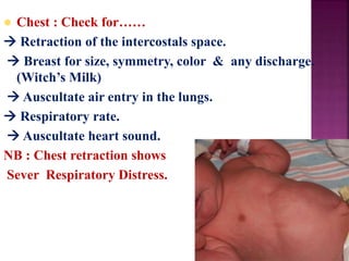  Chest : Check for……
 Retraction of the intercostals space.
 Breast for size, symmetry, color & any discharge.
(Witch’s Milk)
 Auscultate air entry in the lungs.
 Respiratory rate.
 Auscultate heart sound.
NB : Chest retraction shows
Sever Respiratory Distress.
 