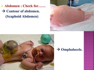 Abdomen : Check for……
 Contour of abdomen.
(Scaphoid Abdomen)
 Omphalocele.
 