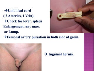 Umbilical cord
( 2 Arteries, 1 Vein).
Check for lever, spleen
Enlargement, any mass
or Lump.
Femoral artery pulsation in both side of groin.
 Inguinal hernia.
 