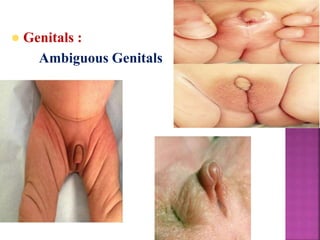  Genitals :
Ambiguous Genitals
 