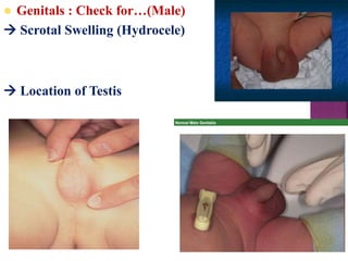  Genitals : Check for…(Male)
 Scrotal Swelling (Hydrocele)
 Location of Testis
 