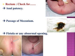  Rectum : Check for……
 Anal patency.
 Passage of Meconium.
 Fistula or any abnormal opening.
 