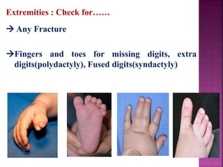 Extremities : Check for……
 Any Fracture
Fingers and toes for missing digits, extra
digits(polydactyly), Fused digits(syndactyly)
 