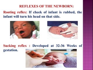 REFLEXES OF THE NEWBORN:
Rooting reflex: If cheek of infant is rubbed, the
infant will turn his head on that side.
Sucking reflex : Developed at 32-36 Weeks of
gestation.
 